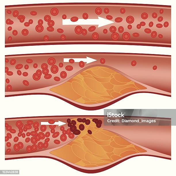 アテローム性動脈硬化 - アテローム性動脈硬化のベクターアート素材や画像を多数ご用意 - アテローム性動脈硬化, コレステロール, 冠動脈
