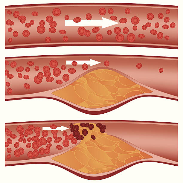 атеросклероз - human artery cholesterol atherosclerosis human heart stock illustrations