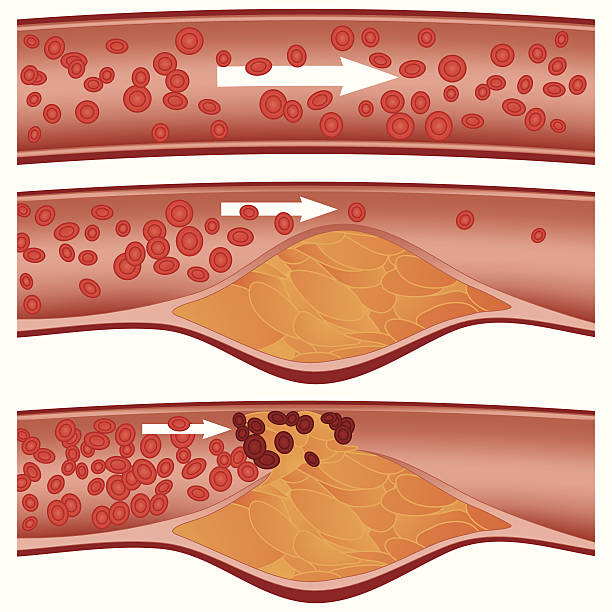 Atherosclerosis Top artery is healthy. Middle & bottom arteries show plaque formation, rupturing, clotting & blood flow occlusion. Gradient mesh is used, which is exclusive to Illustrator. clogged artery stock illustrations