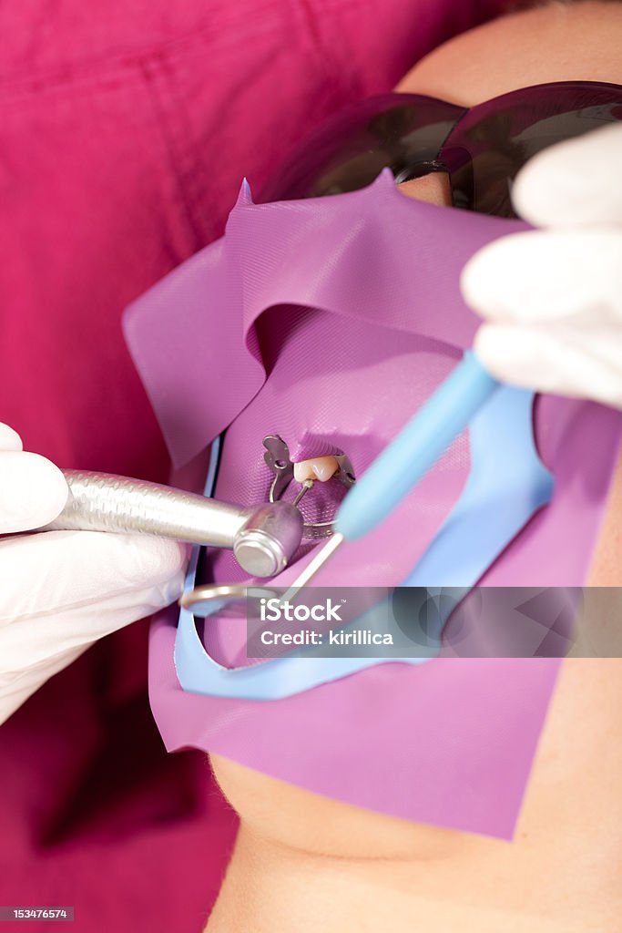 Stomatology Spaß: drilling eine einzelne Zahn - Lizenzfrei Kofferdam Stock-Foto