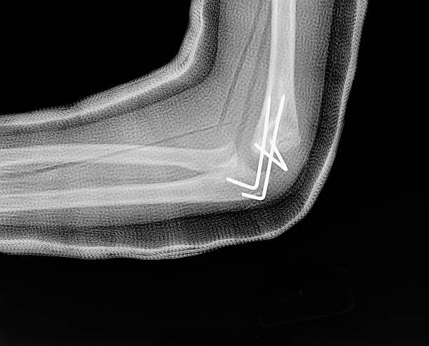 Human Childs Elbow X-ray with Cast and Pins stock photo