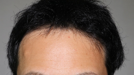 Photo of a Japanese man with thin hair