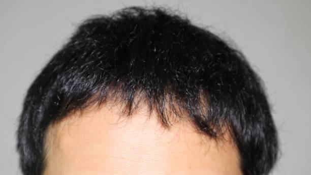 istock Japanese man with thin hair 1536359591