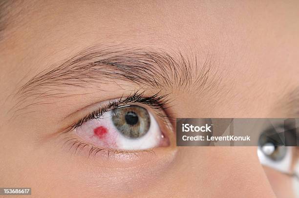 Infezione Oculare - Fotografie stock e altre immagini di Congiuntivite - Congiuntivite, Allergia, Bambino