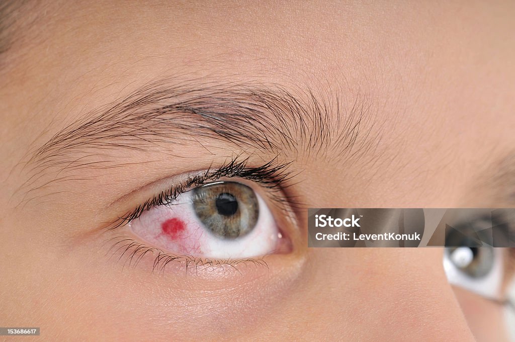 감염된 눈을 - 로열티 프리 결막염 스톡 사진
