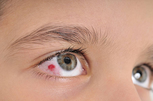 zakażenia oka - conjunctivitis sore eyes child human eye zdjęcia i obrazy z banku zdjęć