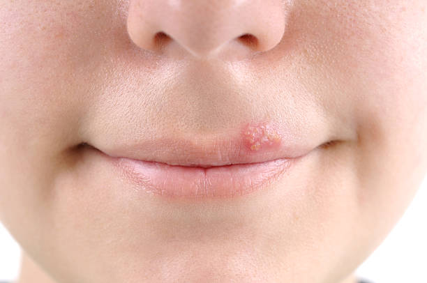 Herpes Close up of lips affected by herpes - a series of MEDICAL related images. herpes stock pictures, royalty-free photos & images