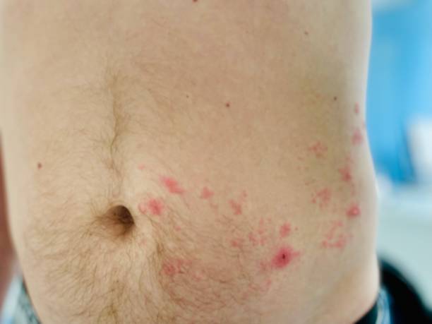 istock herpes zoster shingles 1537042362