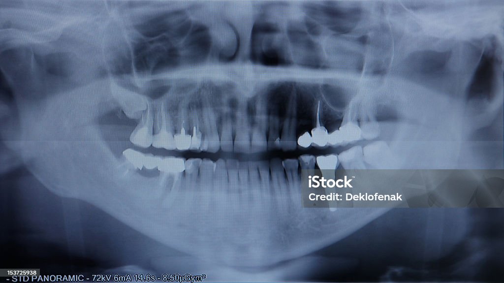 X-ray of human X-ray of the jaw close up Analyzing Stock Photo