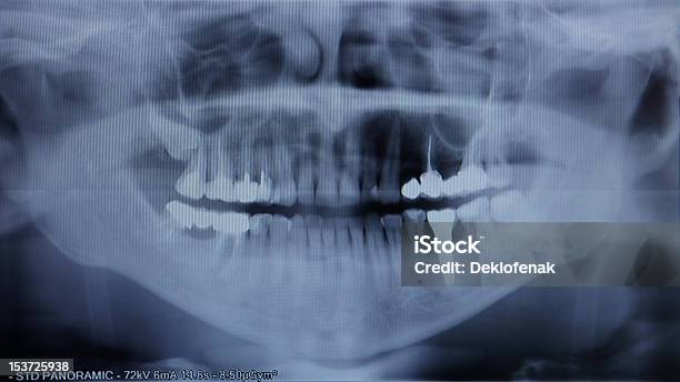 Xray Of Human Stock Photo - Download Image Now - Analyzing, Anatomy, Biology