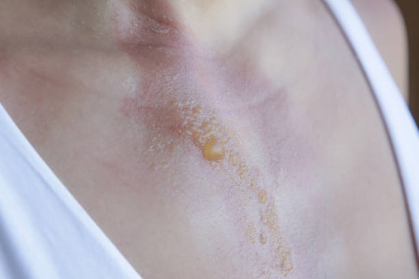 un'ustione di secondo grado con vesciche sul petto della donna - wound sunburned scar physical injury foto e immagini stock