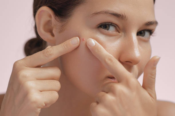 istock Skin Problem. Depressed Woman Touching Pimple On Her Face 1538942178