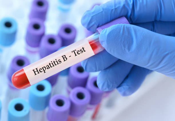 the doctor holds a test blood sample tube with hepatitis b virus (hbv) test on the background of medical test tubes - blood red blood cell blood cell blood sample imagens e fotografias de stock