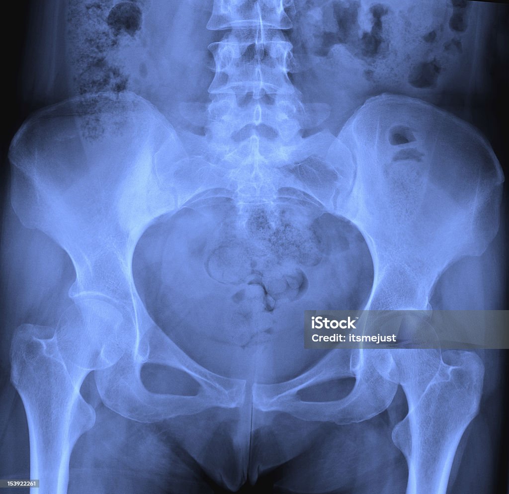 X-ray of pelvis. http://tools.stock-board.info/lightboxes/image-5b6669cea3e58c02cff1df8133f575e7.png Data Stock Photo