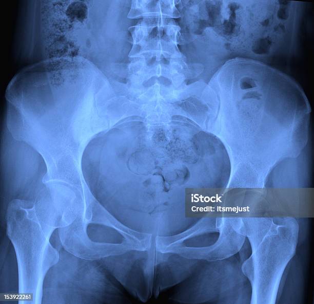 Xray Of Pelvis Stock Photo - Download Image Now - Data, Femur, Healthcare And Medicine