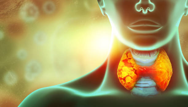 Thyroid gland cancer. showing thyroid gland with tumor. 3d illustration stock photo
