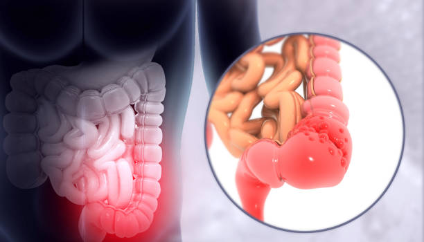 istock Colon cancer. Colon disease. 3d illustration 1539698645
