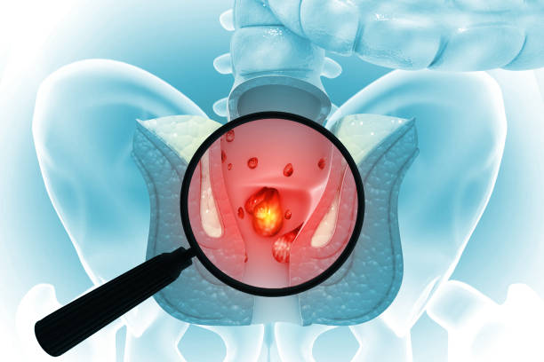 Magnifying glass showing the haemorrhoids (piles) on scientific background. 3d illustration stock photo