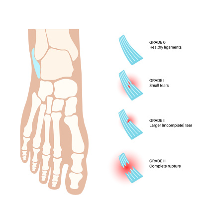 Sprained ankle grades. Twisted feet, pain and swelling. Tears, stretch or rupture of ligaments. Foot trauma anatomical poster, diagnosis and treatment in clinic. Leg injury, X ray vector illustration