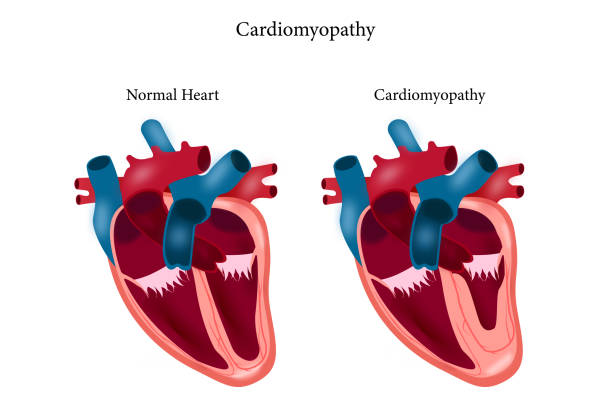 cardiomyopathy Cardiomyopathy. Healthy heart and heart with enlarged and thickened muscle. cross section of human's heart dilation stock illustrations