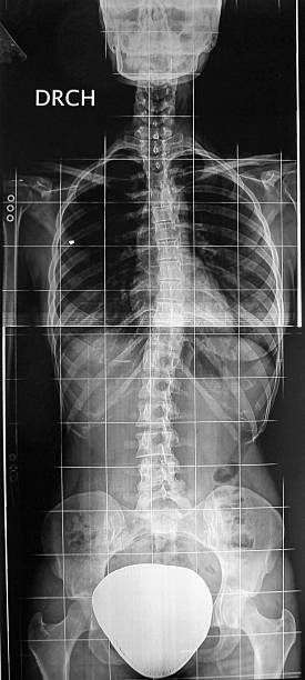radiography - thoracic vertebrae - fotografias e filmes do acervo