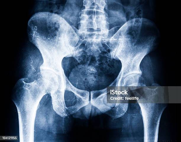 Imagem De Raios X De Anca - Fotografias de stock e mais imagens de Articulação - Parte do corpo - Articulação - Parte do corpo, Articulação humana, Cuidados de Saúde e Medicina