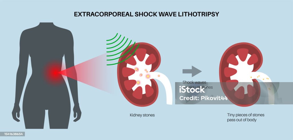 Lithotripsy Procedure Concept Stock Illustration - Download Image Now