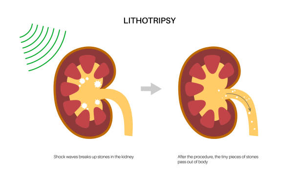 koncepce postupu litotrypsie - rázová vlna stock ilustrace