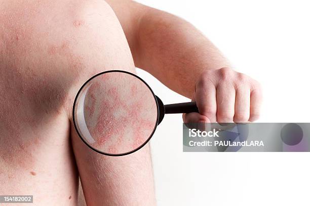 Medical Exam Psoriasis Stock Photo - Download Image Now - Psoriasis, Eczema, Magnifying Glass