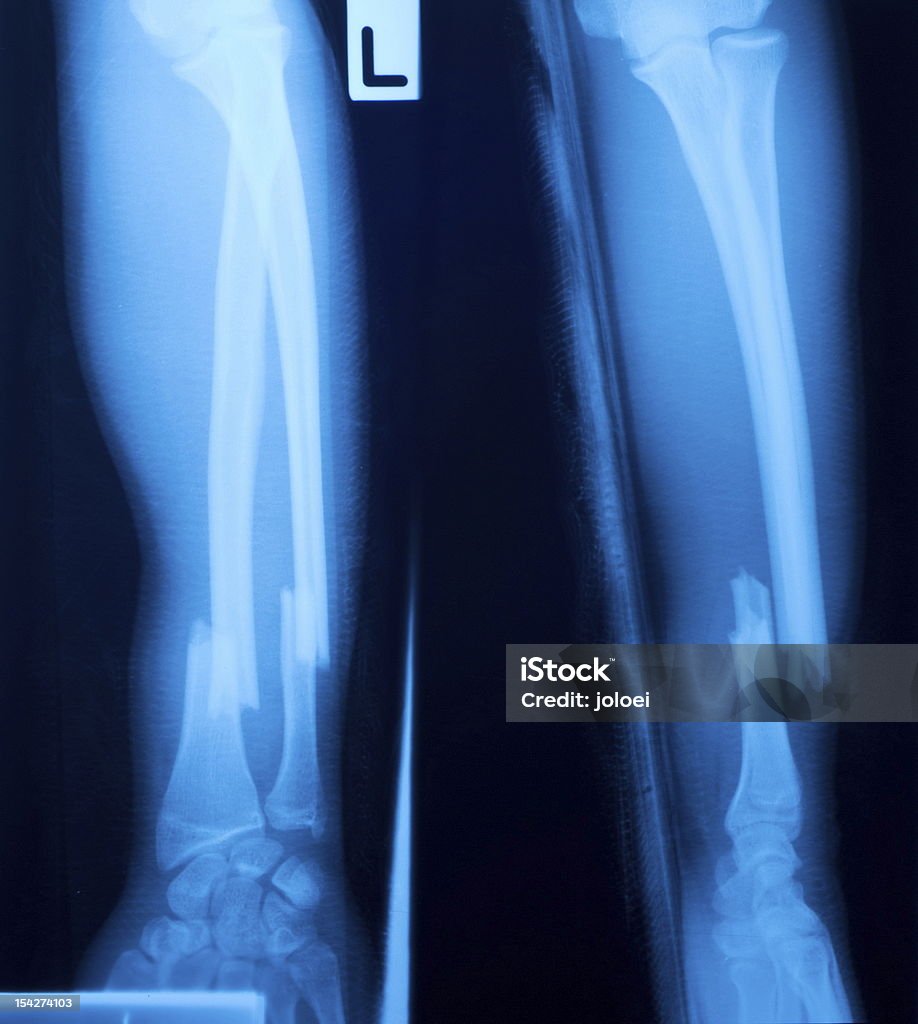 Película de radiografía de la fractura de hueso de la pierna - Foto de stock de Anatomía libre de derechos