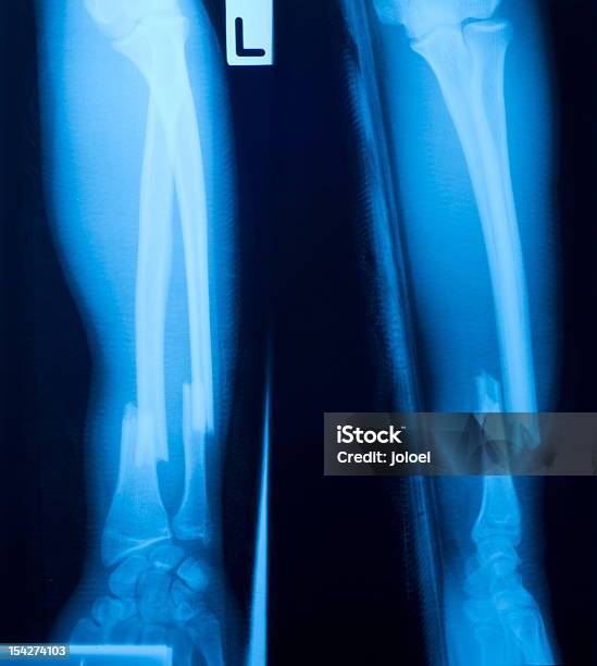 X Ray Слое Кости Левой Ноги — стоковые фотографии и другие картинки Анатомия - Анатомия, Болезнь, Вертикальный