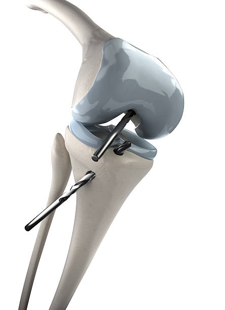 Knee arthroscopy stage 1 CGI - Knee arthroscopy stage 1 posterior cruciate ligament stock pictures, royalty-free photos & images