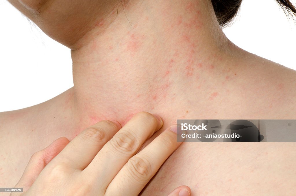 eczema Haut am Hals - Lizenzfrei Atopisches Ekzem Stock-Foto