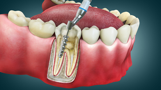 4D Root Canal Image