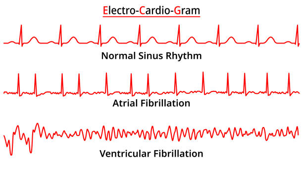 ilustraciones, imágenes clip art, dibujos animados e iconos de stock de conjunto de anomalías comunes del ecg - fibrilación auricular - fibrilación ventricular - ritmo sinusal normal - fibrillation