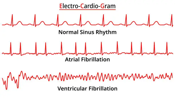Vector illustration of Set of ECG Common Abnormalities - Atrial Fibrillation - Ventricular Fibrillation - Normal Sinus Rhythm