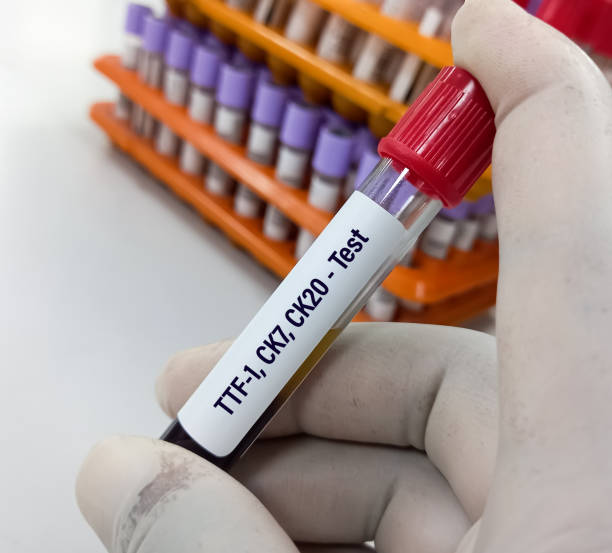 próbka krwi dla ttf-1 (czynnik transkrypcyjny tarczycy-1), ck7, test ck20, marker drobnokomórkowego raka płuca. pierwotny i przerzutowy gruczolakorak płuc. - c._k. zdjęcia i obrazy z banku zdjęć