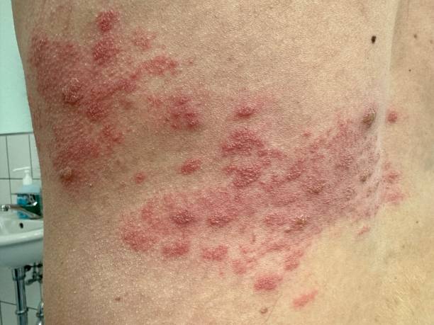 Herpes Zoster (shingles) on human abdomen Herpes Zoster (shingles) on human abdomen. Varizella Zoster skin infection shingles rash stock pictures, royalty-free photos & images