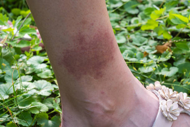 большое красное пятно на ноге после укуса клеща крупным планом, болезнь лайма - lyme disease стоковые фото и изображения
