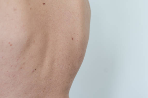 istock Psoriasis skin disease is a dermatic problem, red allergic skin rash. 1547950717