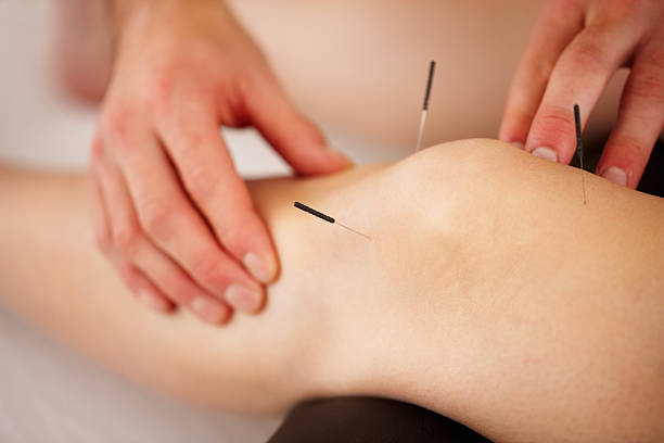 Acupuncture treatment View of woman's leg with acupuncture needles acupuncture photos stock pictures, royalty-free photos & images