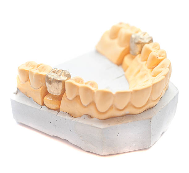 набор зубы с золотой зубная пломба на гипс - dentures human teeth stack laboratory стоковые фото и изображения