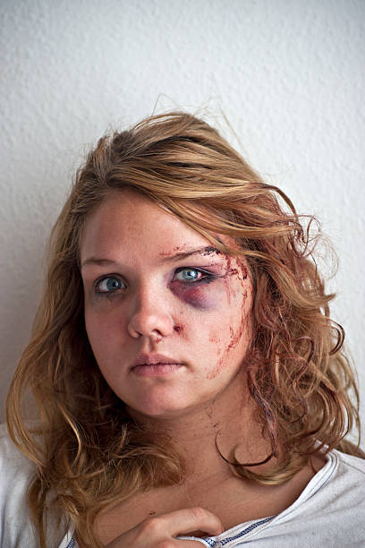 Young woman with eye injury stock photo