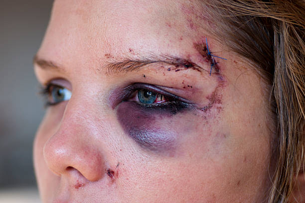 Young woman with eye injury - close up stock photo