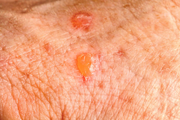 Actinic Keratosis skin cancer Actinic Keratosis two days after a freezing removal treatment scab arm stock pictures, royalty-free photos & images