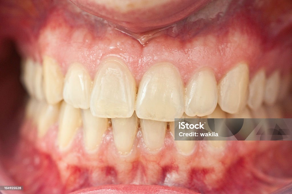 一連の健康なヒト-mit Zahnfleisch zähne入れ歯 - �ヒトの歯茎のロイヤリティフリーストックフォト