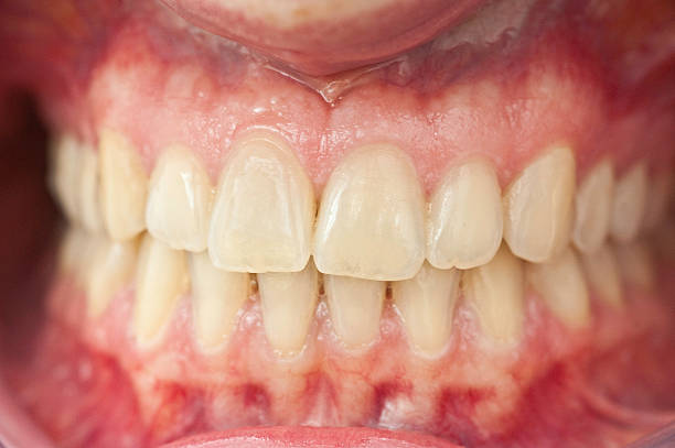 conjunto de saúde humana dentárias-zähne mit zahnfleisch - healthy gums fotos imagens e fotografias de stock