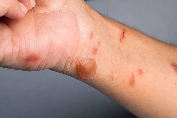 Woman arm with actual second degree burn stock photo