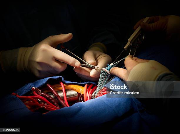 Intervento Di Chirurgia Cardiaca Valvola Aortica Sostituzione - Fotografie stock e altre immagini di Intervento di chirurgia cardiaca