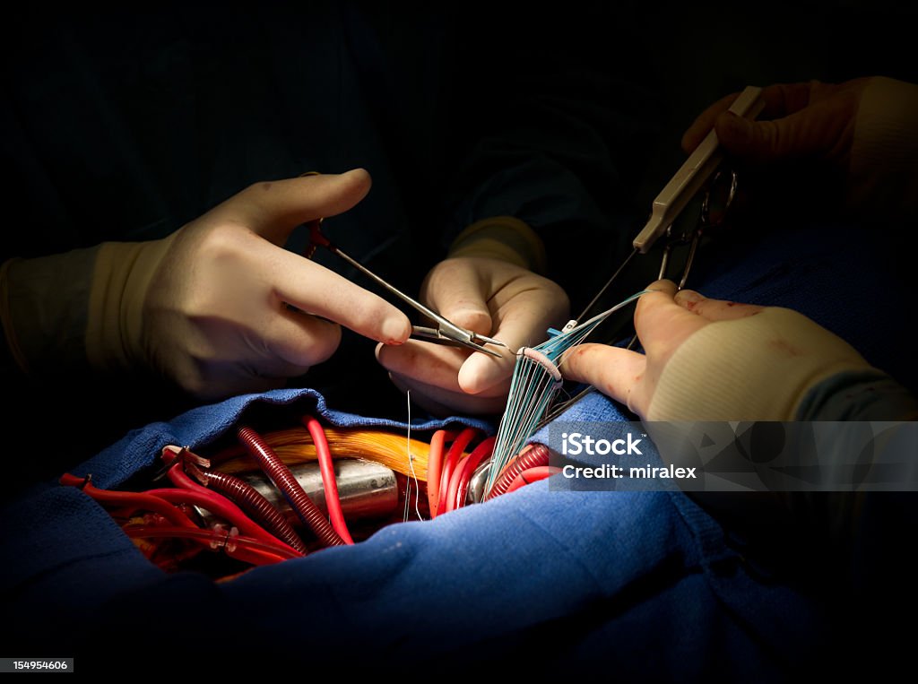 心臓手術大動脈弁の交換 - 心臓手術のロイヤリティフリーストックフォト